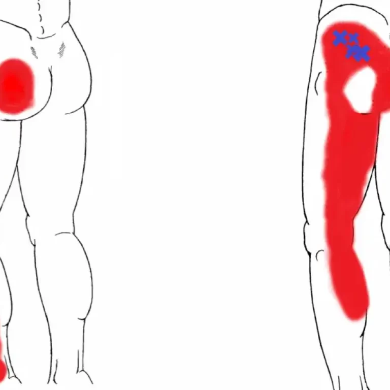 Gluteus Minimus
